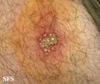 herpes simplex
