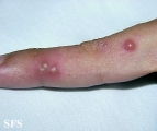 herpes simplex