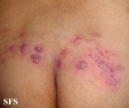 herpes simplex