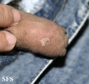 herpes simplex