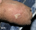 herpes simplex