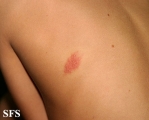 herpes simplex