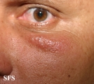 herpes simplex
