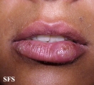 herpes simplex