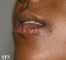 herpes simplex