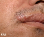 herpes simplex