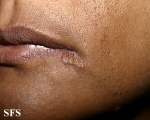 herpes simplex