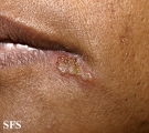 herpes simplex