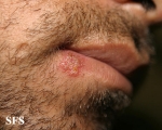 herpes simplex