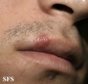 herpes simplex