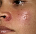 herpes simplex