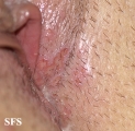 herpes simplex