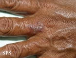 herpes simplex