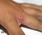 herpes simplex