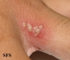 herpes simplex