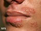 herpes simplex