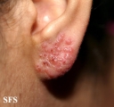 herpes simplex