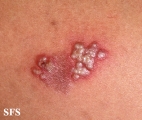 herpes simplex