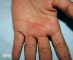 herpes simplex