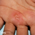herpes simplex