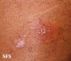 herpes simplex