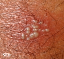 herpes simplex