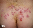 herpes simplex