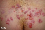 herpes simplex