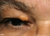 xanthelasma palpebrarum