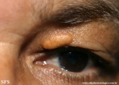 xanthelasma palpebrarum