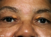 xanthelasma palpebrarum