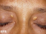 xanthelasma palpebrarum