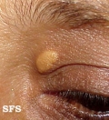 xanthelasma palpebrarum
