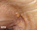 xanthelasma palpebrarum