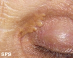xanthelasma palpebrarum