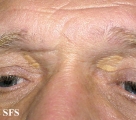 xanthelasma palpebrarum