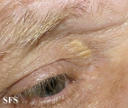 xanthelasma palpebrarum