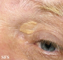xanthelasma palpebrarum