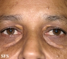 xanthelasma palpebrarum