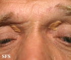 xanthelasma palpebrarum