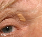 xanthelasma palpebrarum