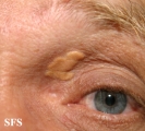 xanthelasma palpebrarum
