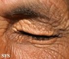 xanthelasma palpebrarum