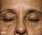 xanthelasma palpebrarum