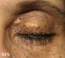 xanthelasma palpebrarum