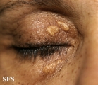 xanthelasma palpebrarum