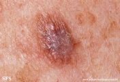 lichenoid_keratosis