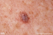 lichenoid_keratosis