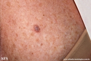 lichenoid_keratosis