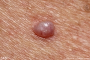 myxoma-cutaneous_myxoma